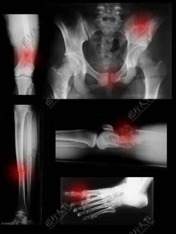 腿部X光片图图片