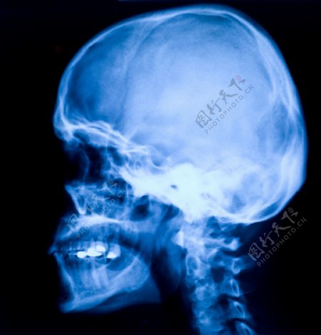 头颅骨骼CT图片