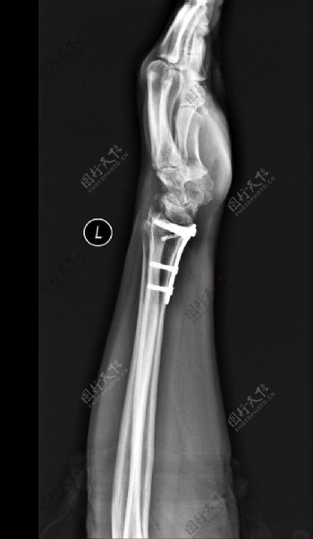 X线照片腕关节图片