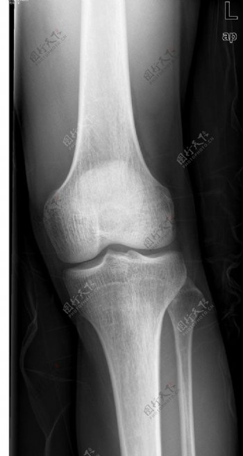 膝盖骨科医生x光图片