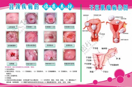子宫肌瘤图图片