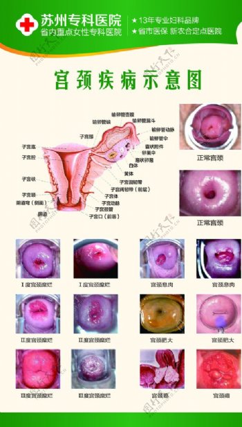 宫颈疾病海报图片