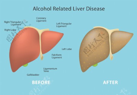 酒精相关的肝脏疾病