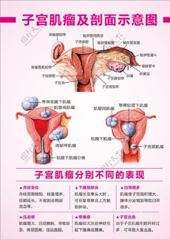 子宫肌瘤示意图子宫肌瘤表现